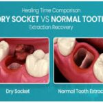 pictures of dry socket vs normal healing